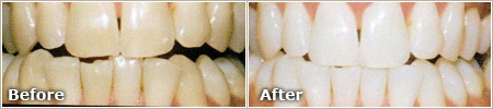 Genetic Stains Before and After Whitening