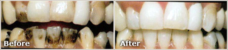 Smoking Stains Before and After Whitening