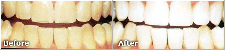 teeth stained by aging before and after teeth whitening treatment