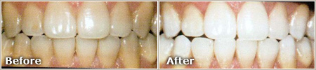 Tetracycline Stains Before and After Whitening