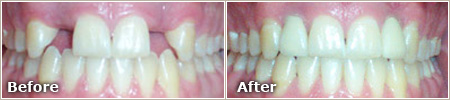 missing teeth replaced by dental implants before and after treatment