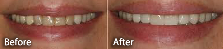 before and after for stained teeth and teeth whitening treatment