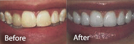 stained and whitened teeth before and after a teeth whitening treatment