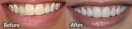 slightly yellowed teeth before and after a teeth whitening treatment