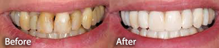 severely stained teeth before and after a teeth whitening treatment