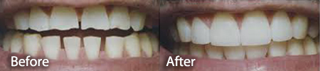 gapped and damaged teeth before and after treatment