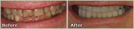 patient with discolored and damaged teeth before treatment and straight, white teeth after treatment