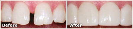 gapped front teeth before treatment, evenly placed and proportional teeth after treatment