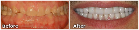 dull, gummy and uneven teeth before treatment; even, white and properly aligned teeth after treatment