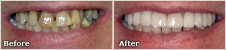 wide gaps and severe staining of the teeth before treatment, even and white teeth after treatment