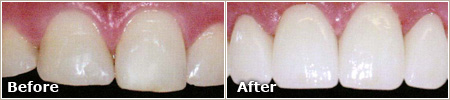 slightly dull and uneven teeth before treatment, even and white teeth after treatment